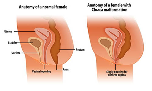 MalformacaoCloacal