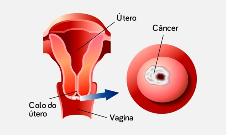 O meu testemunho sobre o cancro do colo do útero