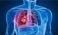 Tuberculose: como podes proteger-te