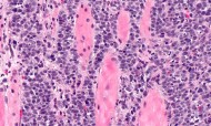 HPV - Vírus do Papiloma Humano: como se transmite e como se trata